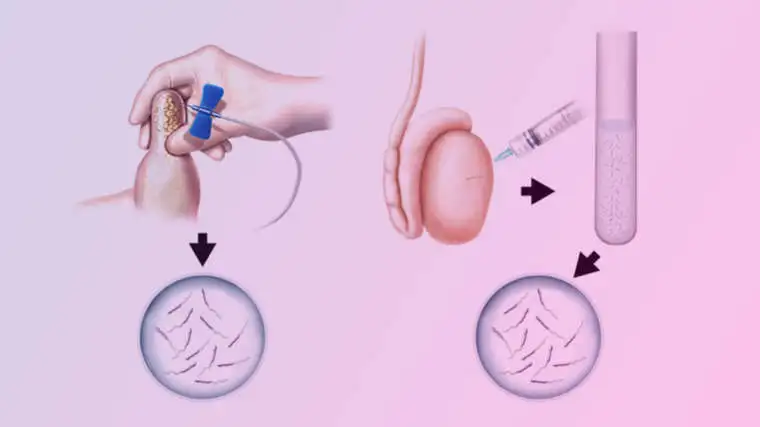 Intra Cytoplasmic Sperm Injection