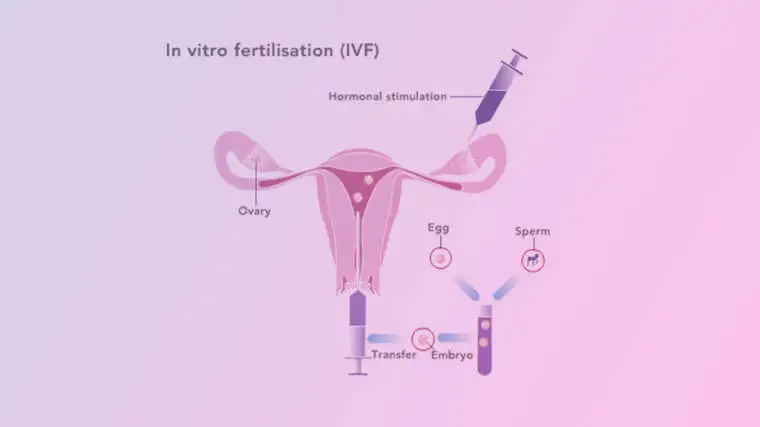 IVF ( In Vitro Fertilization or Test Tube Baby)